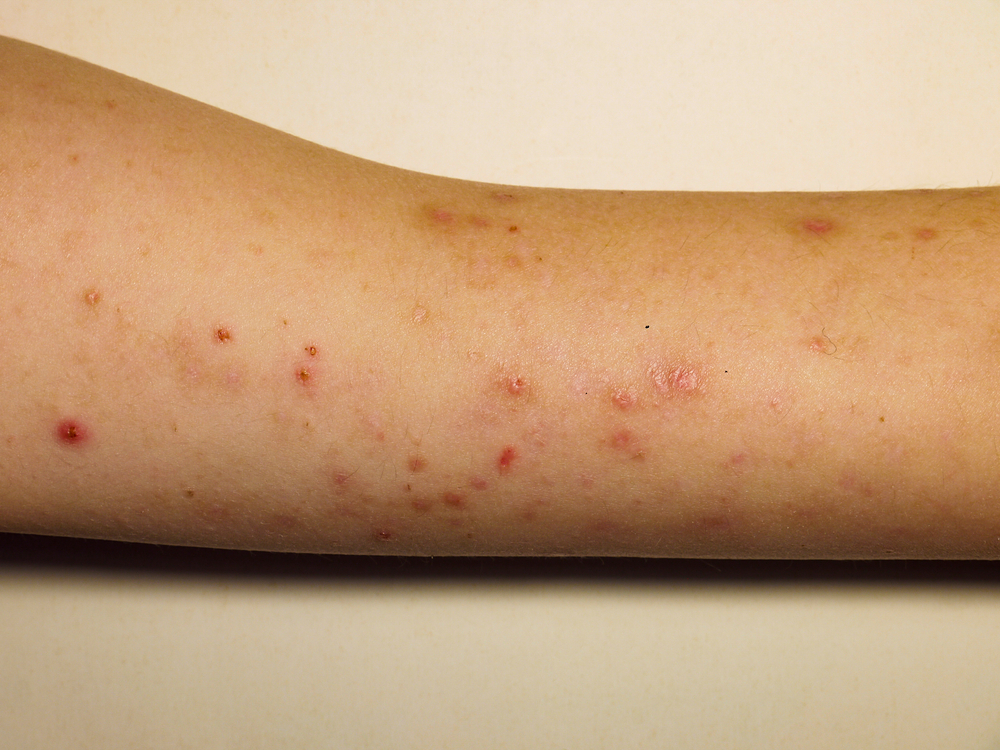 Skin Rashes COVID 19 Pandemic | Dr. Michael Steppie