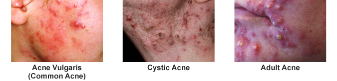 Image of different types of acne we treat in orlando